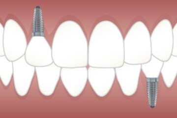 front tooth replacement