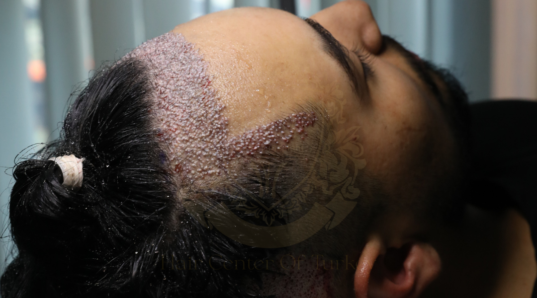 Advantages of Hair Transplant at Hair Center of Turkey