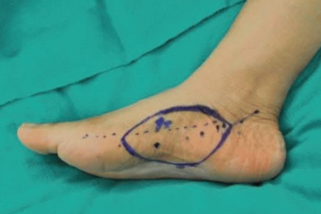 Plantar Perforator Treatment