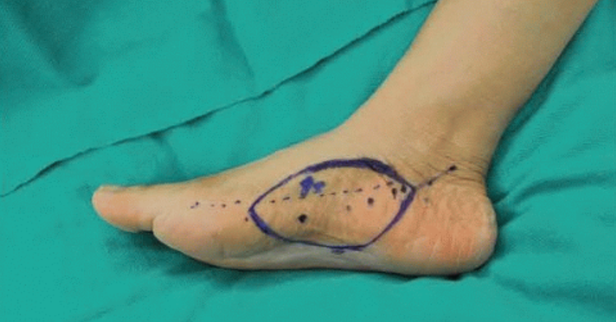 Plantar Perforator Treatment